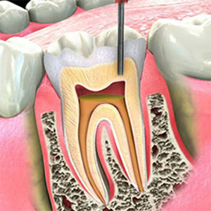 300-endodonzia